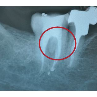 Biodentine 5 x 0,7 g