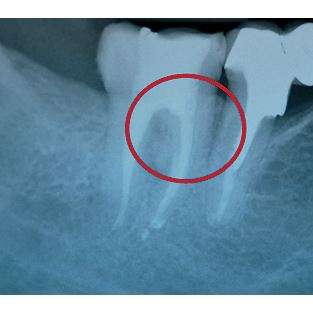 Biodentine 5 x 0,7 g