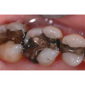 Biodentine 5 x 0,7 g