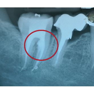 Biodentine 5 x 0,7 g