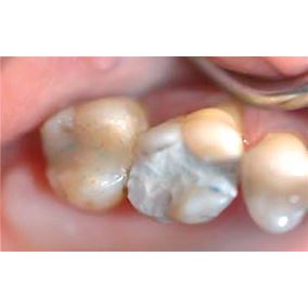 Biodentine 5 x 0,7 g