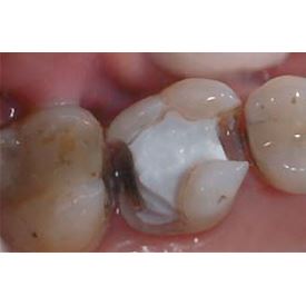 Biodentine 5 x 0,7 g