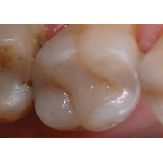 Biodentine 5 x 0,7 g