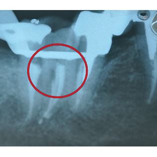 Biodentine 5 x 0,7 g